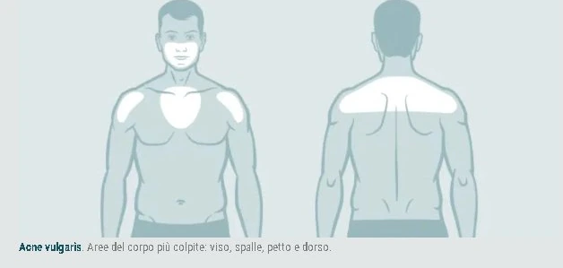 Illustrazione delle aree del corpo più colpite dall'acne: viso, spalle, petto e dorso
