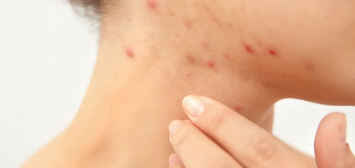 Acne sul corpo — manifestazione clinica visibile su torace e schiena