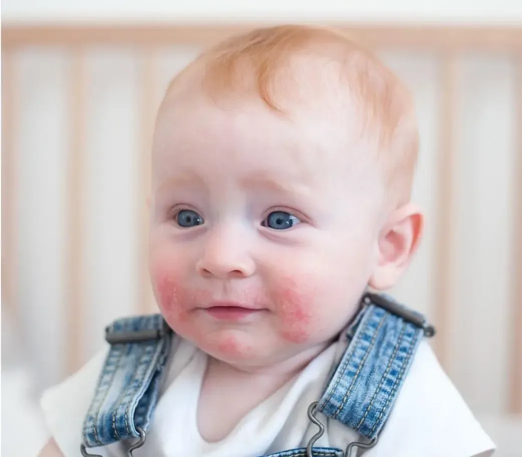 Centro Eudermia Cagliari - Dermatologia pediatrica