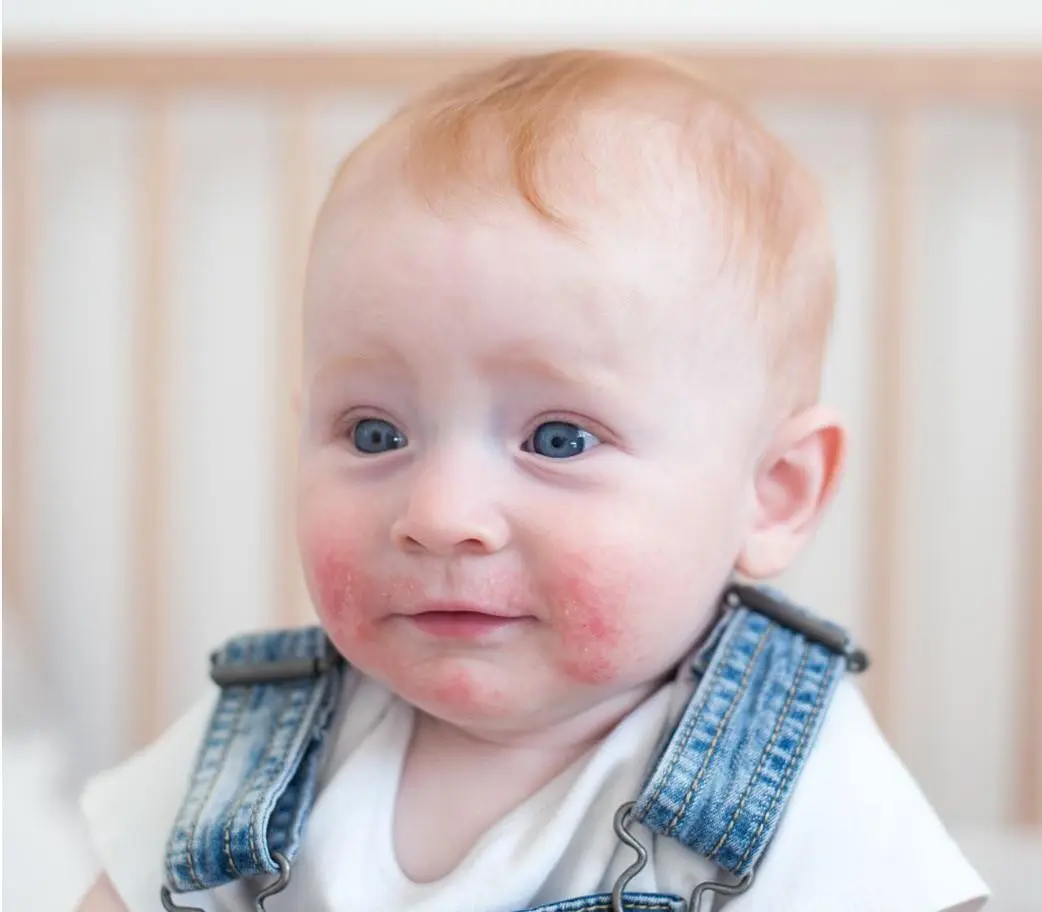 Dermatologia pediatrica - Centro Eudermia Cagliari