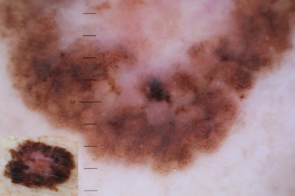 Il Percorso Oncologico Eudermia - Centro Eudermia Cagliari