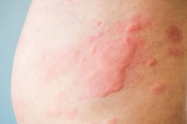 Centro Eudermia Cagliari - Trattamento dell'orticaria