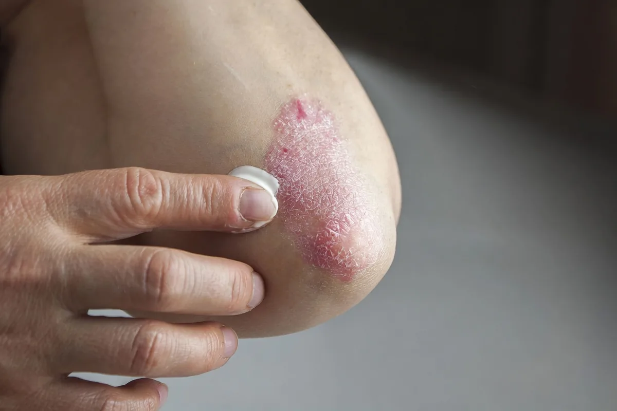 Centro Eudermia Cagliari - Trattamento della psoriasi