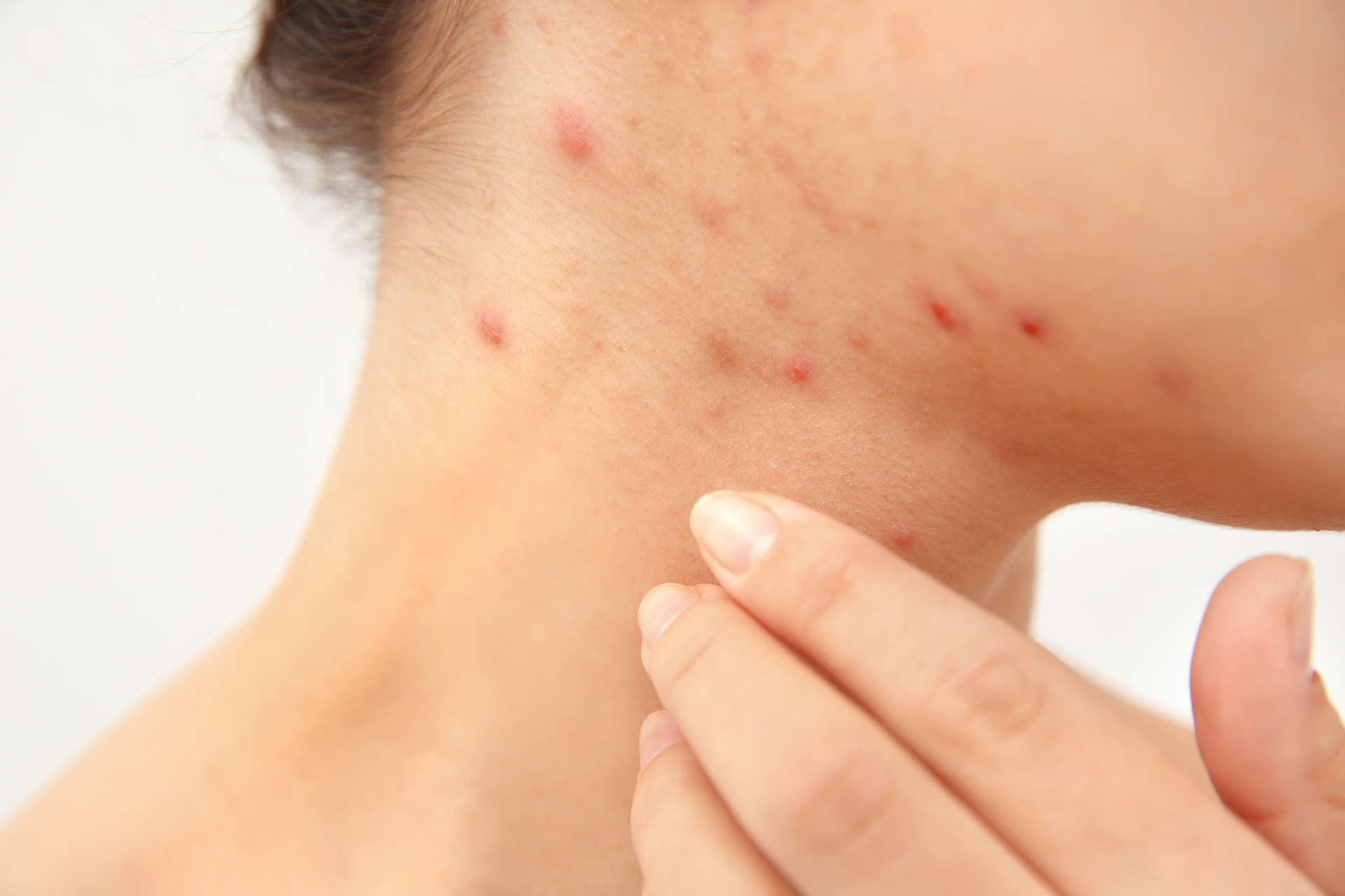 Dermatologo-Cagliari-Guicciardi-Terapia per l’acne
